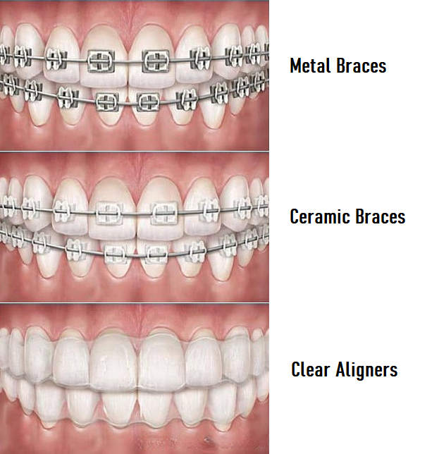 ΟΡΘΟΔΟΝΤΙΚΗ